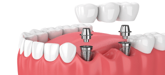 Dental Implants