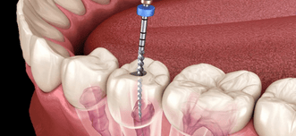 Root Canal Therapy